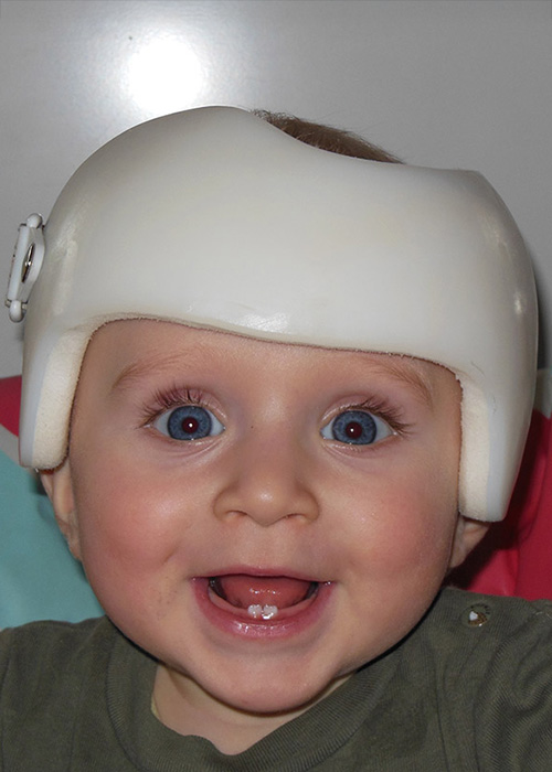 Kind mit Helm für Helmtherapie
